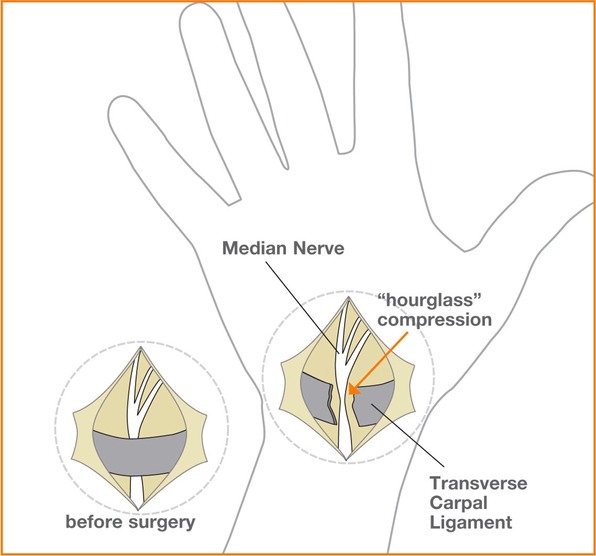 Carpal_Image3