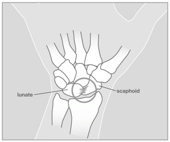 Wristsprains_image2